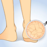 Prevence syndromu diabetické nohy